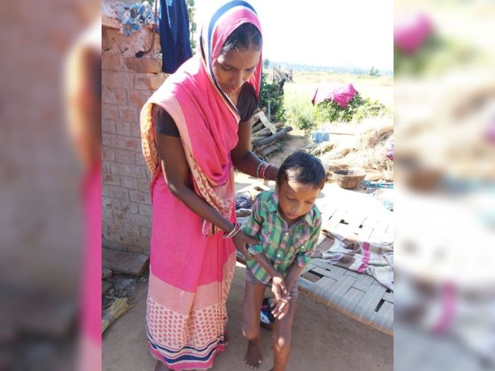 शहडोल में 16 हजार बच्चे कुपोषित, इन